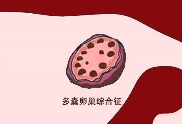 多囊可以选择做ppos试管方案