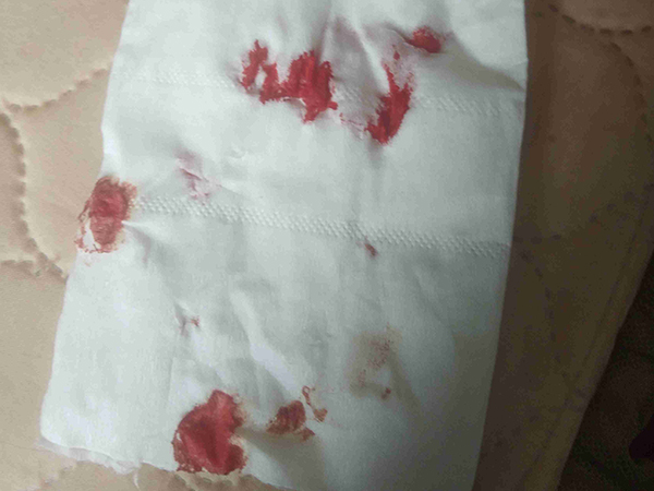吃补佳乐后会药物性出血