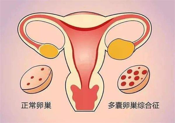 拮抗剂方案适合多囊卵巢综合征患者